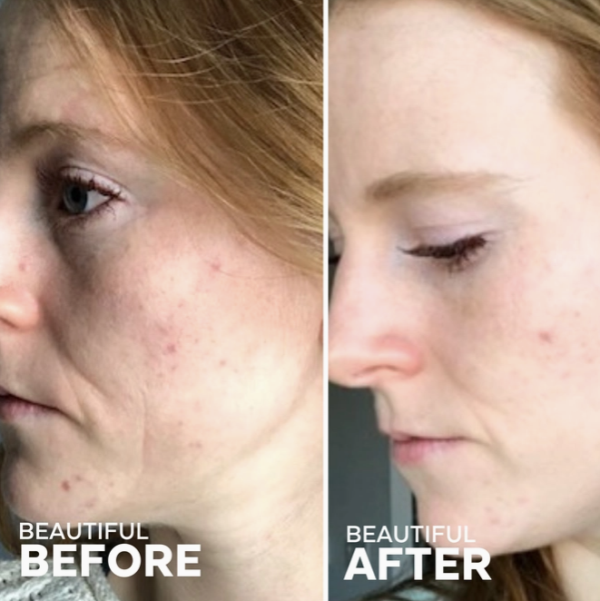 In the Clear 3-Step Kit For Blemish-Prone Skin (3 Full-Size)