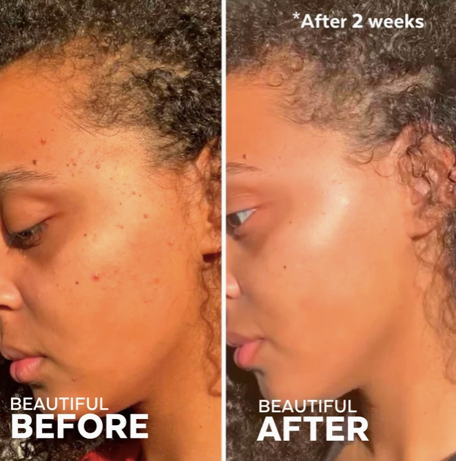 In the Clear 3-Step Kit For Blemish-Prone Skin (3 Full-Size)